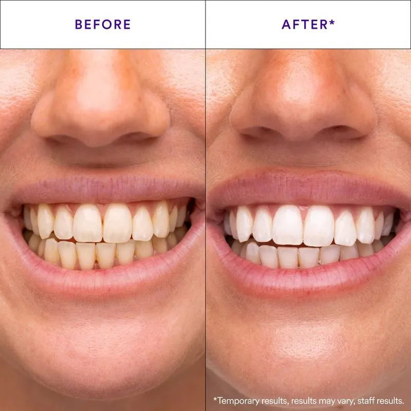 ✨ Advanced Purple Whitening Strips