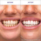 ✨ Advanced Purple Whitening Strips