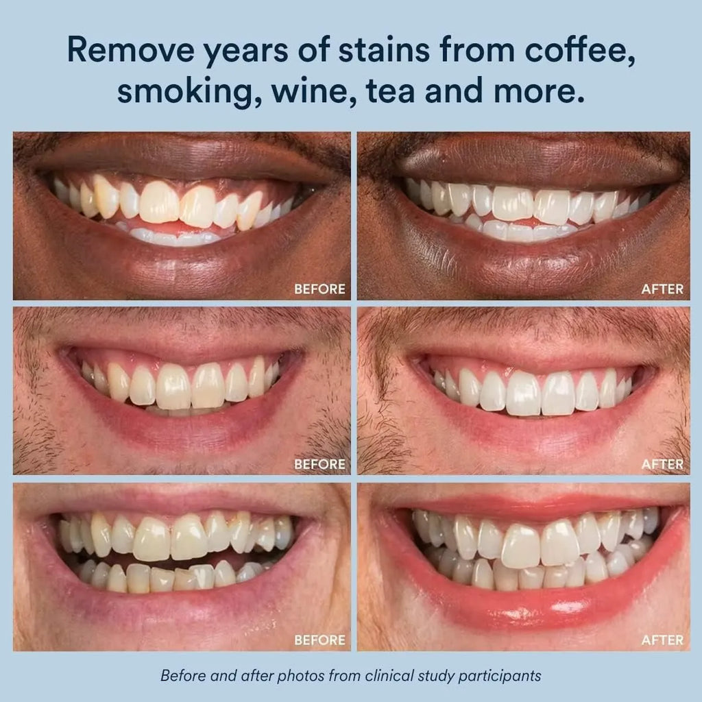 ✨ Advanced Purple Whitening Strips
